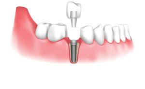 Dental Implants San Diego - Brite Smile Dental
